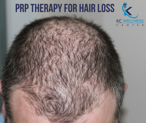 PRP Therapy for Hair Loss